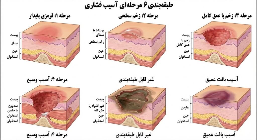نمودار تصویری طبقهبندی استاندارد ۶ مرحلهای آسیب فشاری، از قرمزی پایدار پوست (مرحله ۱) تا آسیب وسیع بافت و استخوان (مرحله ۴) و مراحل غیرقابل طبقهبندی، جهت راهنمایی در تشخیص و انتخاب پروتکل مناسب درمان زخم بستر.