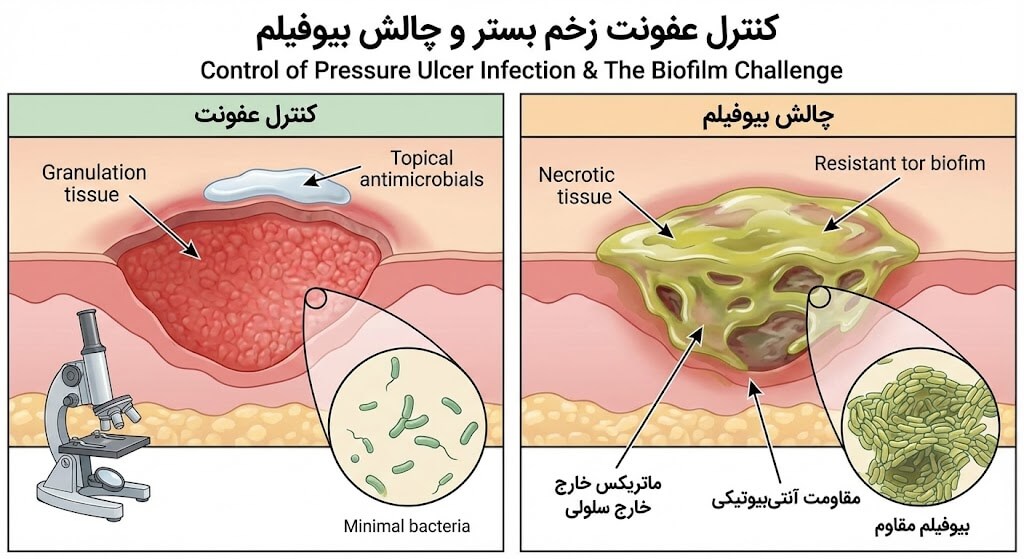 مقایسه نموداری یک زخم بستر در حال بهبود با بافت گرانوله و کنترل عفونت، در مقابل یک زخم مزمن دارای بیوفیلم باکتریایی مقاوم و بافت نکروتیک، که نشاندهنده یکی از چالشهای اصلی در درمان زخم بستر است.