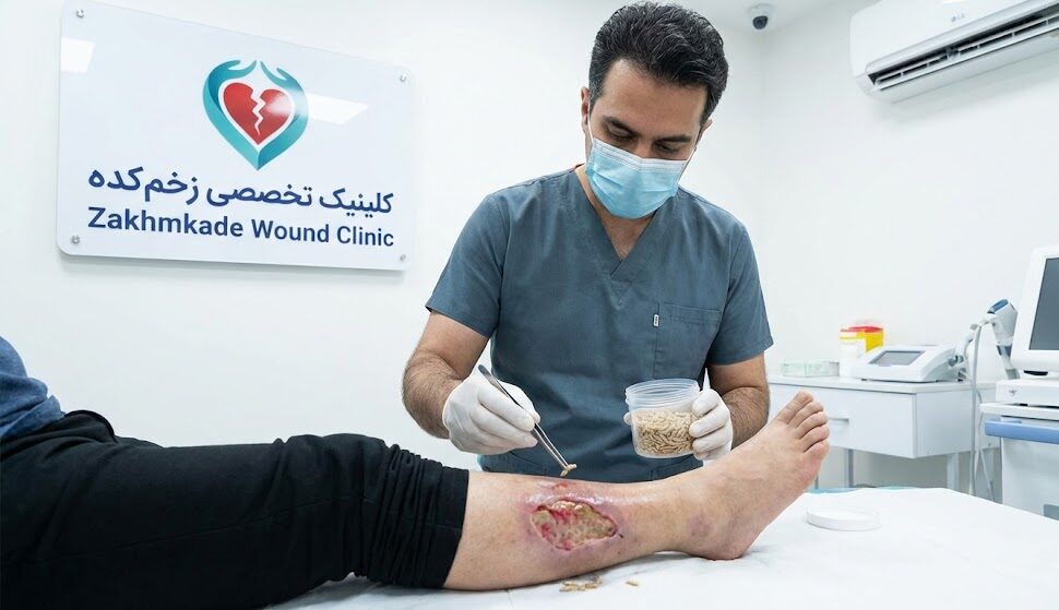 متخصص درمان زخم در حال انجام لارو درمانی روی پای بیمار در کلینیک تخصصی زخمکده در تهران.
