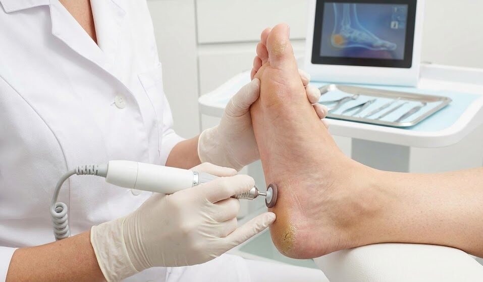 متخصص پودولوژی در حال استفاده از دستگاه کراتوریموال روی پاشنه پا به عنوان یک روش نوین درمان زخم و پیشگیری از ترک.