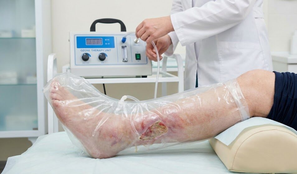 پای بیمار دارای زخم مزمن درون کیسه مخصوص تحت درمان با گاز اوزون به عنوان یک روش نوین درمان زخم قرار دارد.