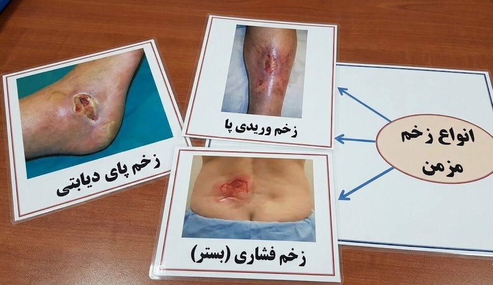 نمایش تصویری و مقایسهای انواع زخم مزمن شامل زخم پای دیابتی، زخم وریدی و زخم فشاری (بستر) روی کارتهای آموزشی.