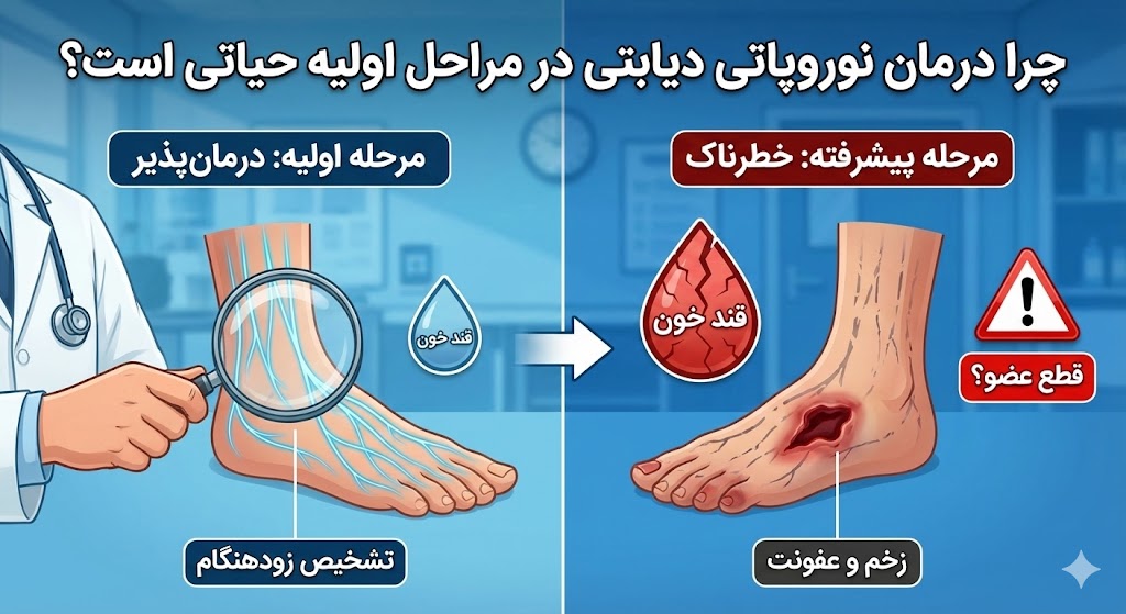 اینفوگرافیک مقایسه اهمیت شروع سریع درمان نوروپاتی دیابتی در مرحله اولیه (سمت چپ) نسبت به خطرات مرحله پیشرفته مثل زخم و قطع عضو (سمت راست).