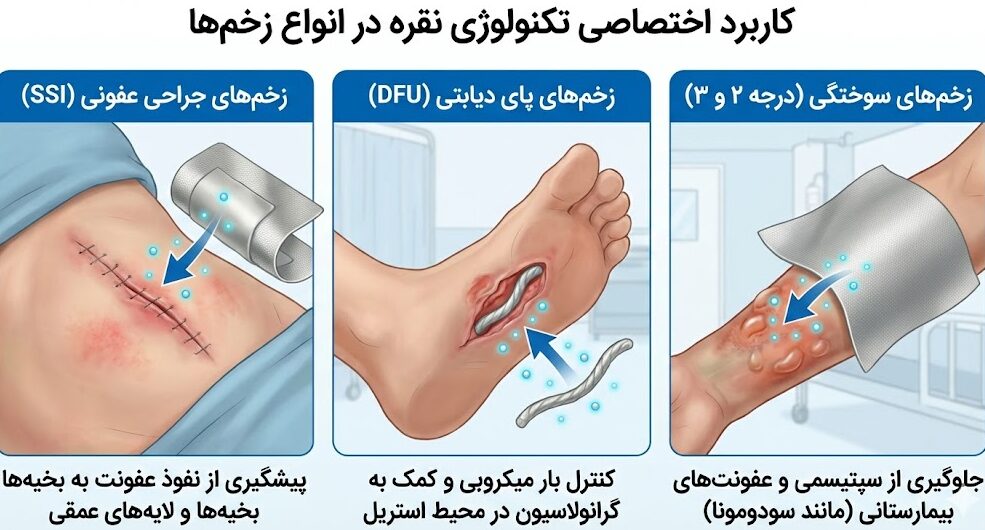 راهنمای تصویری کاربرد تکنولوژی نقره در درمان زخمهای جراحی (SSI)، زخم پای دیابتی (DFU) و سوختگیهای درجه ۲ و ۳.